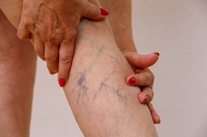 Munculnya Urat Biru di Lutut Dan Paha Bukan pertanda Parises